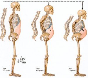 Osteoporosis Osteoporosis