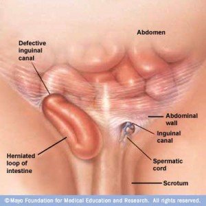 Penyakit hernia Penyakit hernia